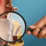 hemorrhoids