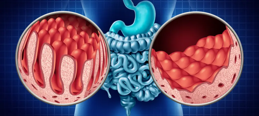 testing for celiac disease villi 